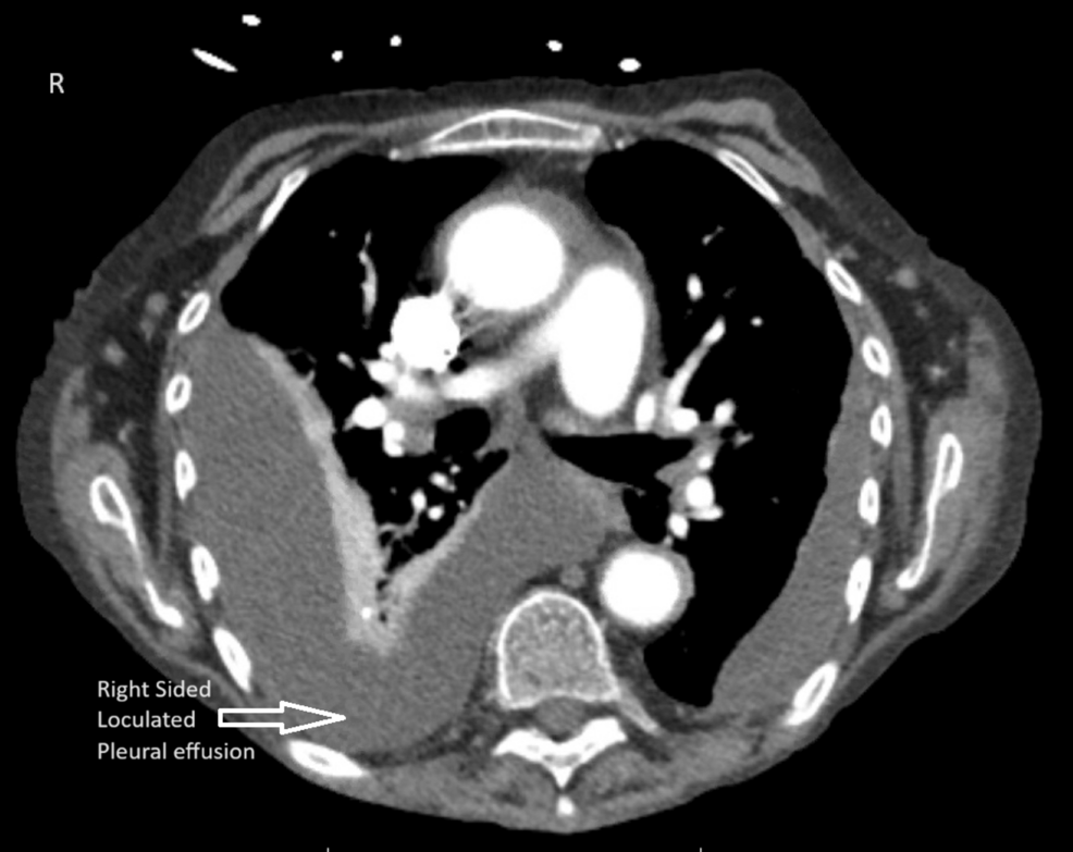 Lung Entrapment Secondary To Loculated Rheumatoid Effusions Treated 