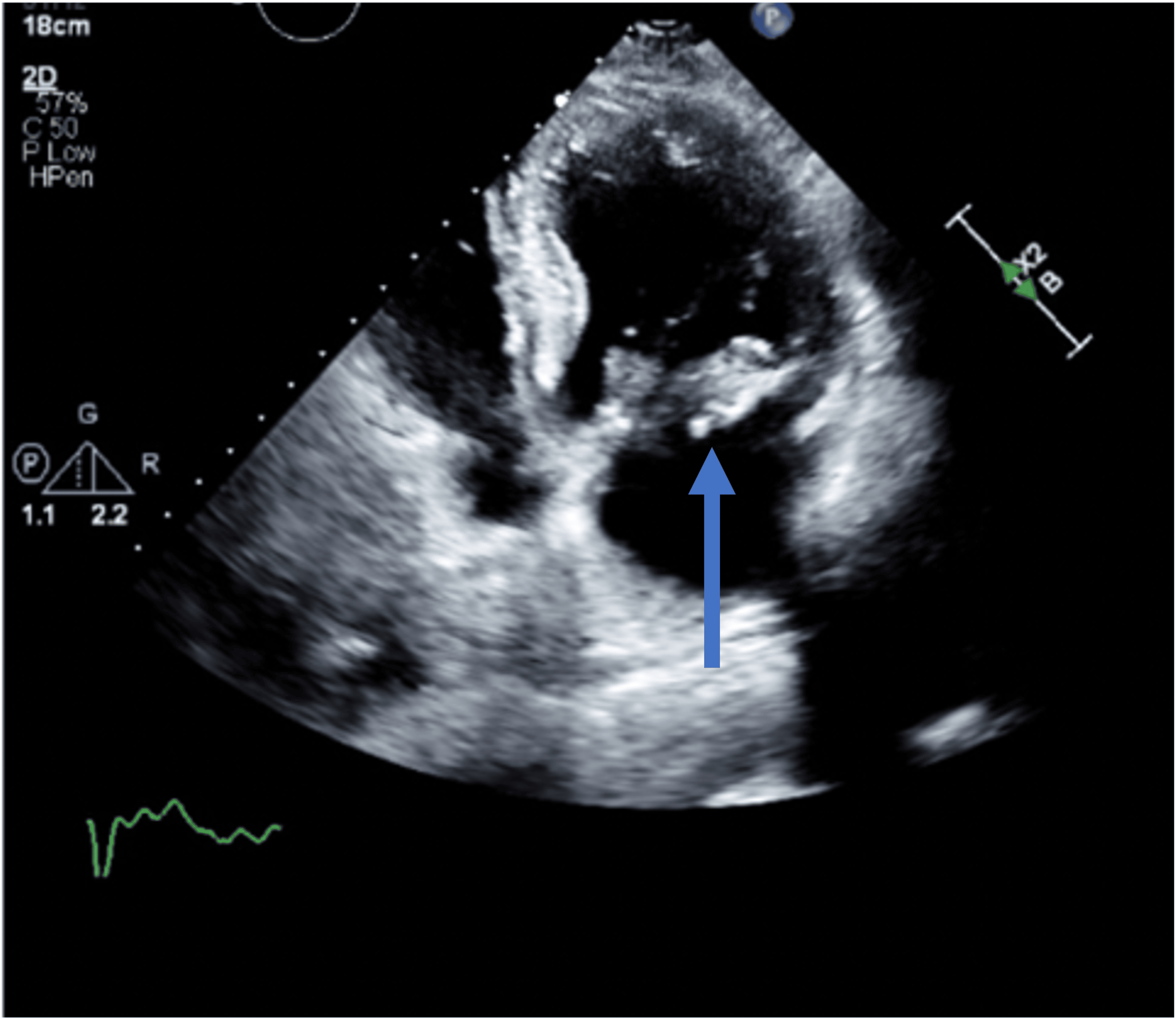 A Case of Granulicatella adiacens Osteomyelitis and Mitral Valve ...