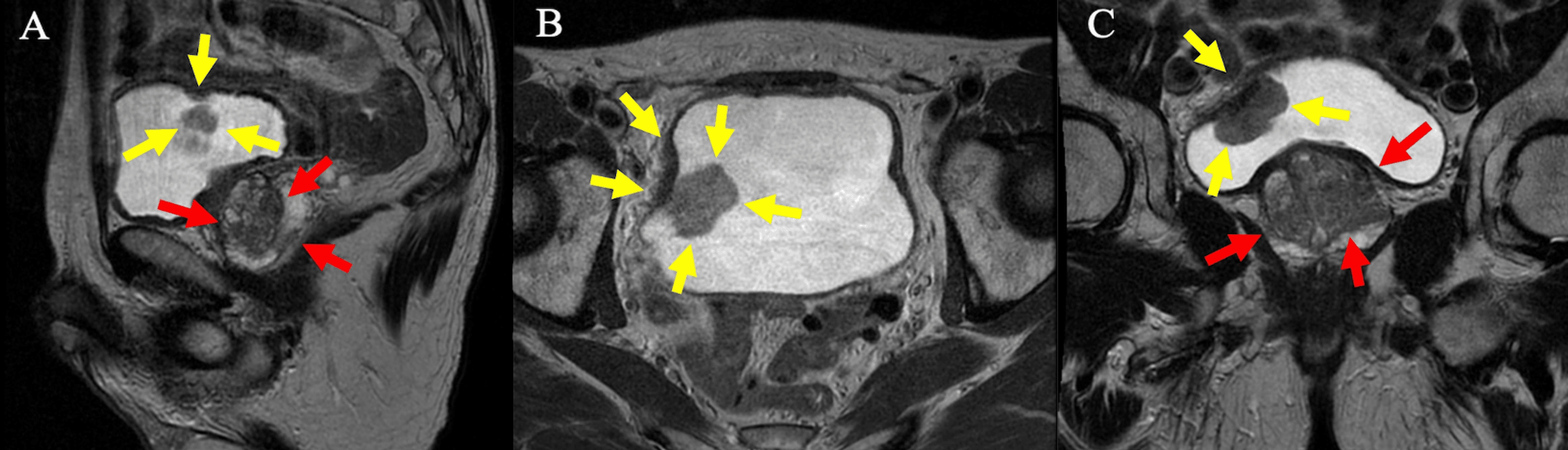 Implementation Of Cone Beam Computed Tomography-guided Online Adaptive 