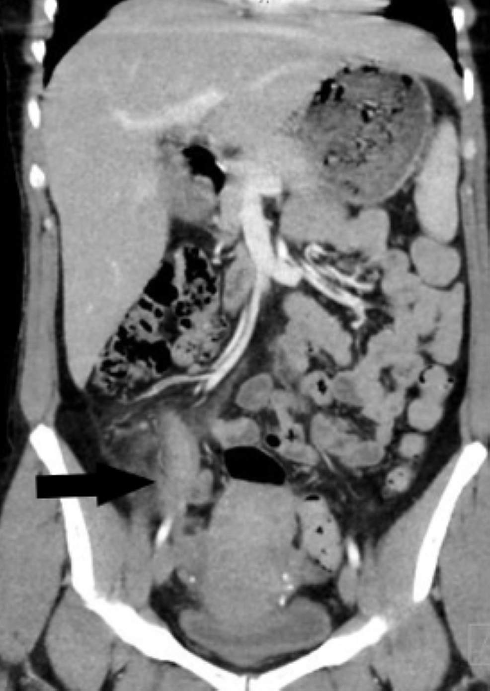 Cureus Appendicitis Caused by Endometriosis Within the Bowel Wall