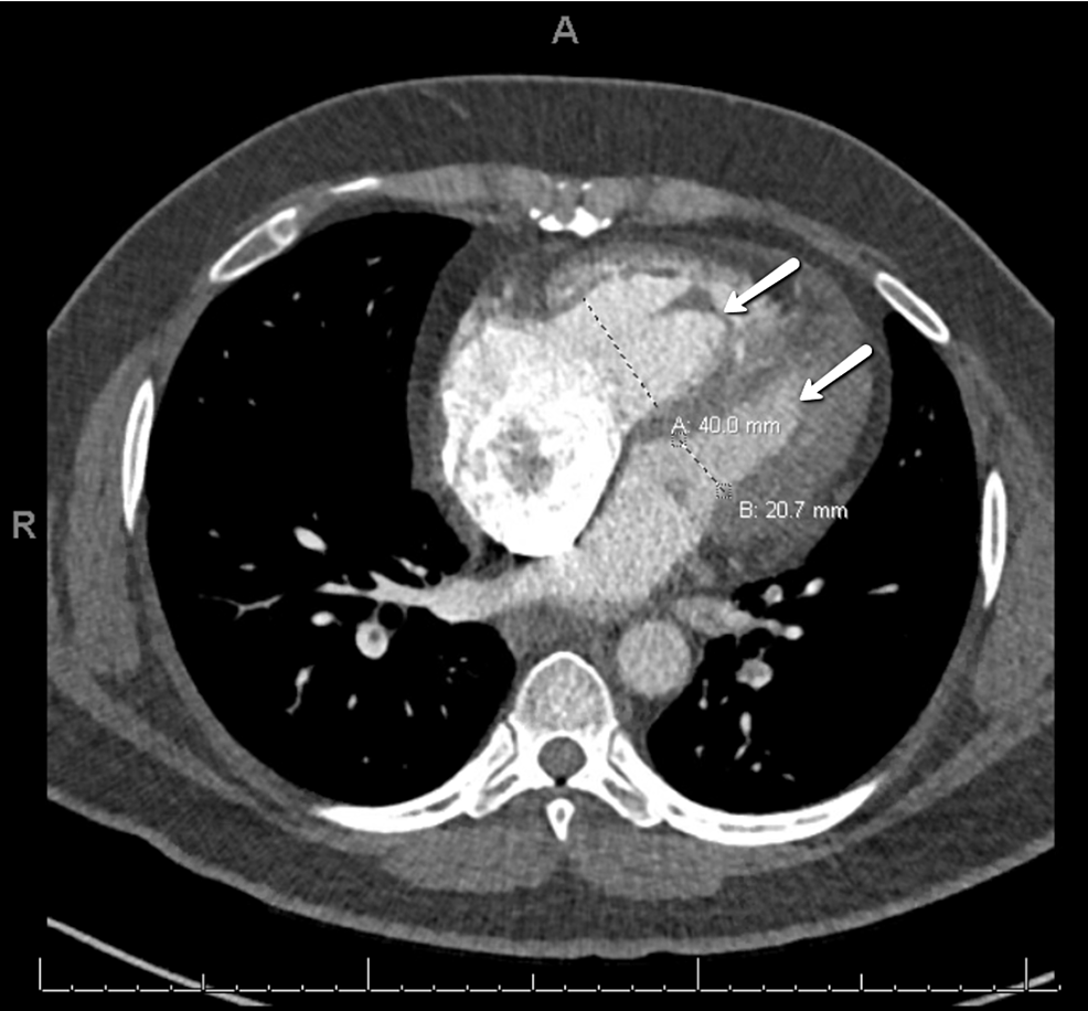 CT.-Dilation-of-the-right-ventricle-(40-mm)-relative-to-the-left-ventricle-(20.7-mm).-The-ratio-of-2:1-suggests-right-heart-strain.