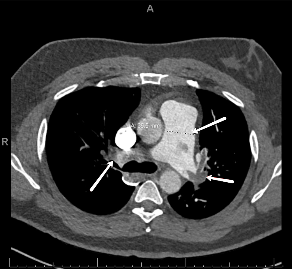 CT.-Obstruction-of-right-and-left-pulmonary-arteries-by-thrombi.-Dilation-of-the-pulmonary-artery-to-35.5-mm.
