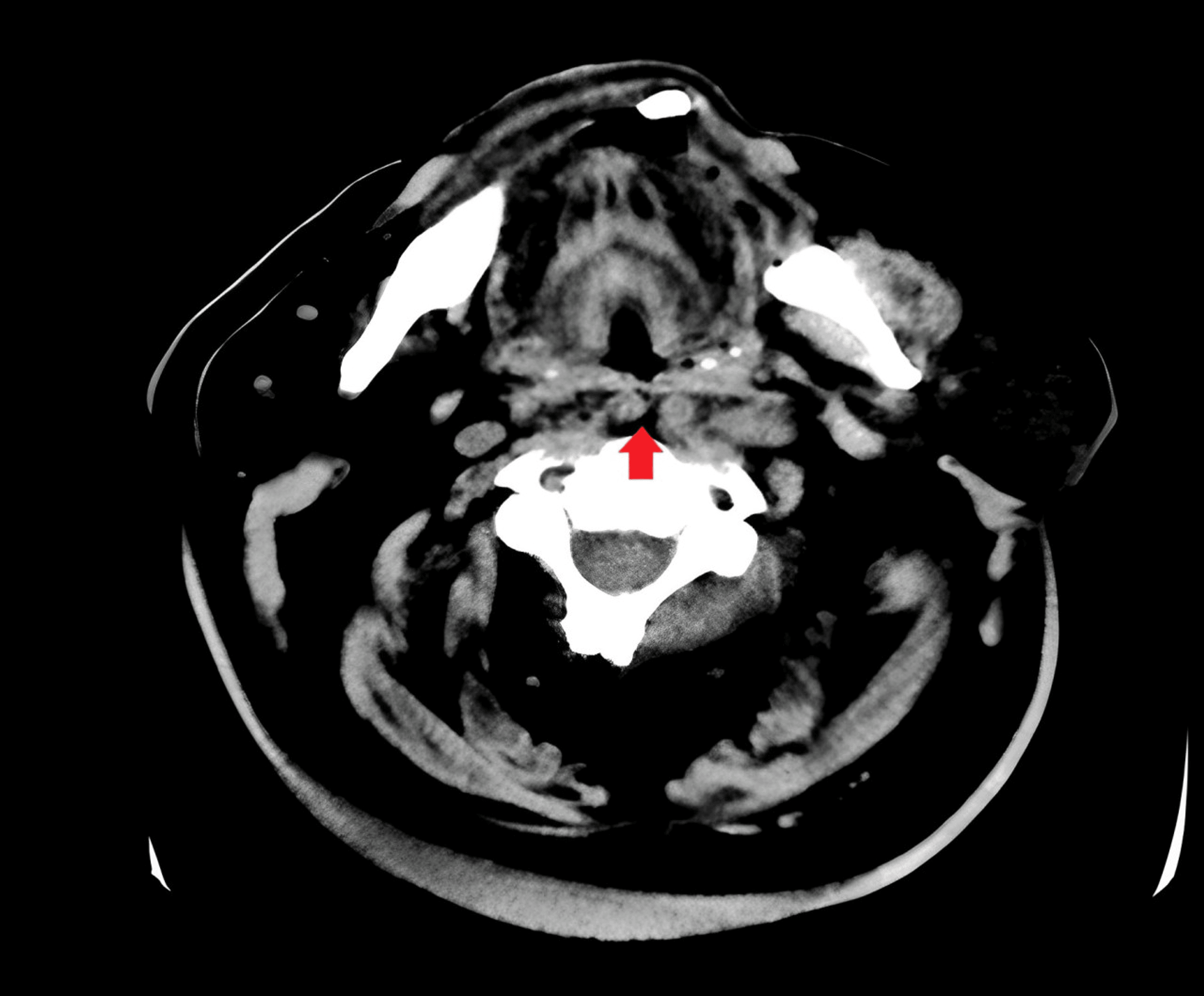 Pictures Of Scars From Carotid Artery Surgery - nz2ycv8