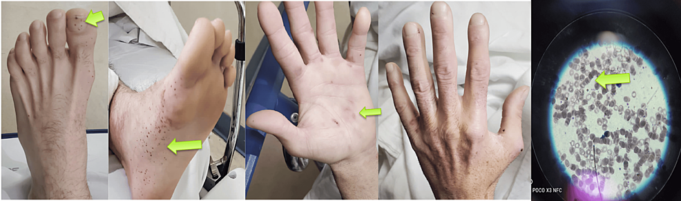 Physical-examination-on-admission-revealed-splinter-hemorrhages-on-the-toes,-Janeway-lesions-as-erythematous-macular-lesions-on-the-palm,-and-rouleaux-formation-on-the-blood-smear Physical-examination-on-admission-revealed-splinter-hemorrhages-on-the-toes,-Janeway-lesions-as-erythematous-macular-lesions-on-the-palm,-and-rouleaux-formation-on-the-blood-smear