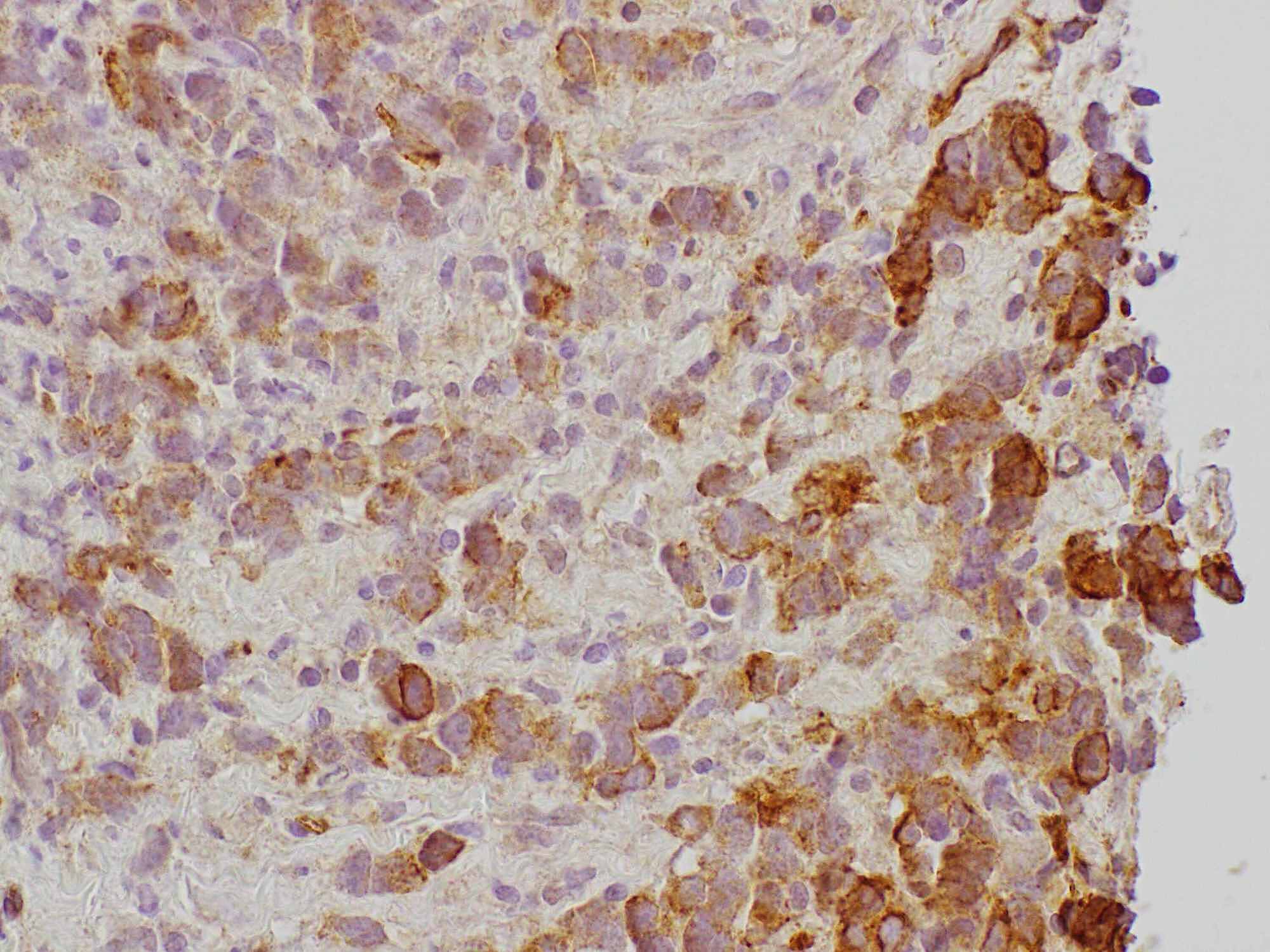 Cureus A Rare Case of a HighGrade Thymic Squamous Cell Carcinoma