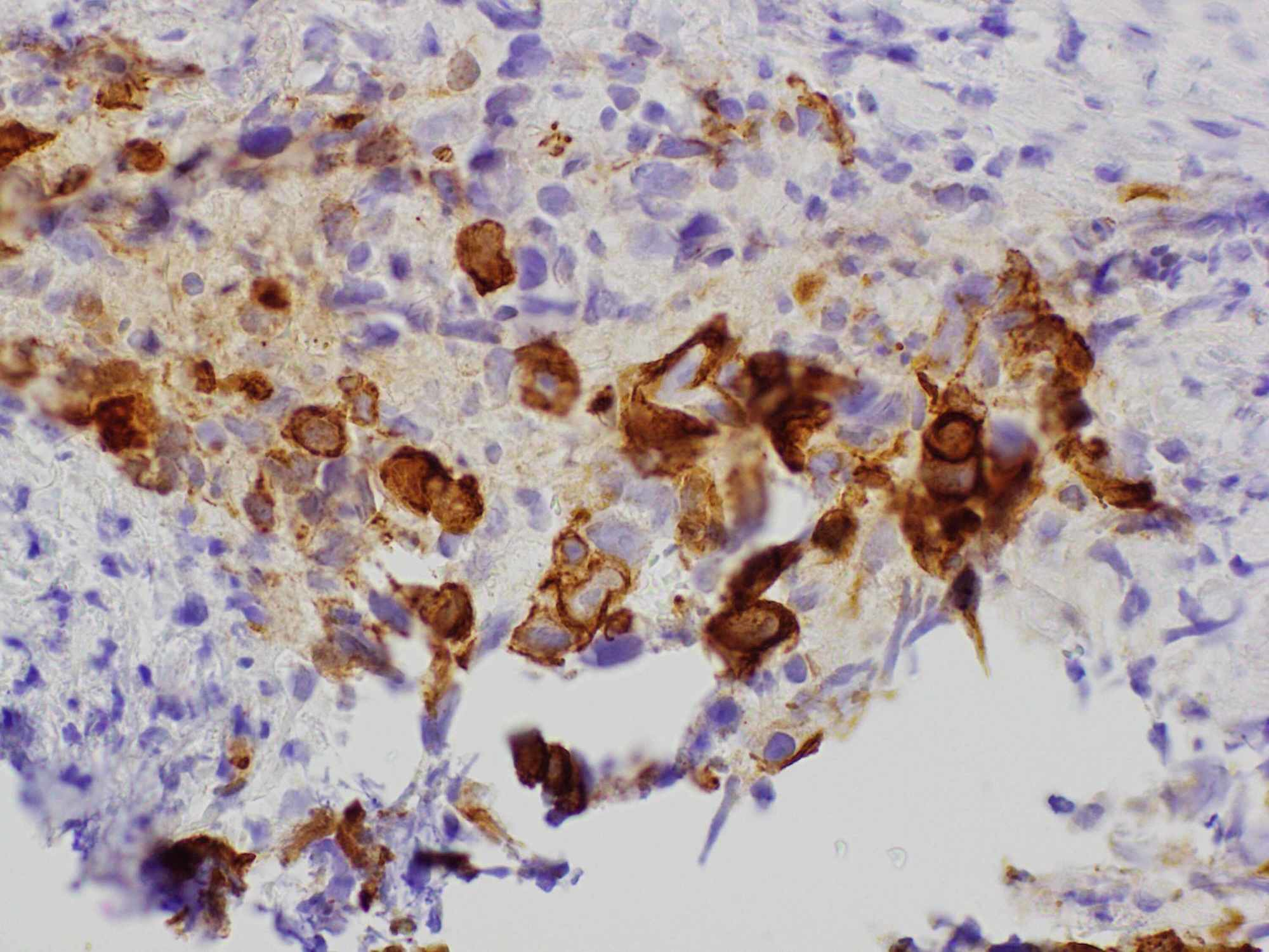 Cureus A Rare Case Of A High Grade Thymic Squamous Cell Carcinoma Presenting As Cardiac Tamponade