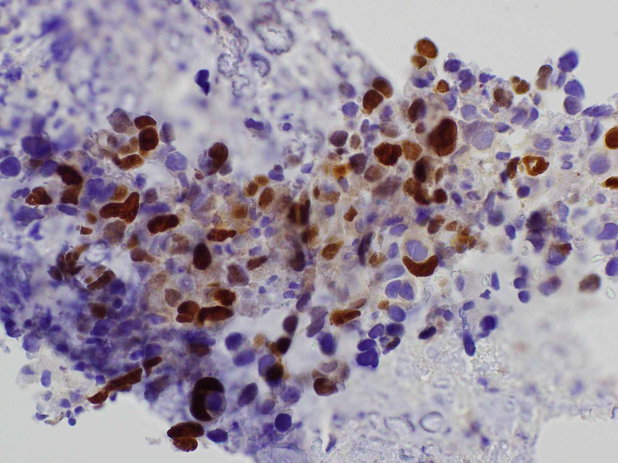 Cureus A Rare Case of a HighGrade Thymic Squamous Cell Carcinoma