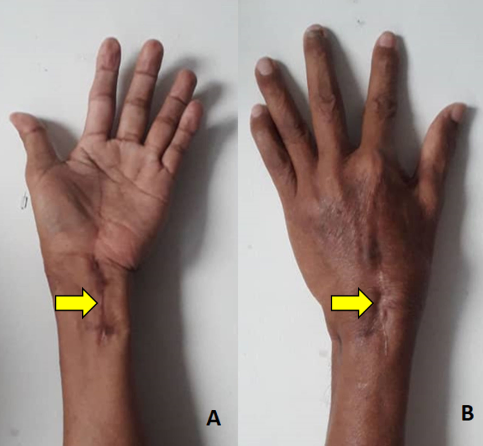 Cureus | Isolated Tuberculosis Of The Wrist: Subtle But Destructive