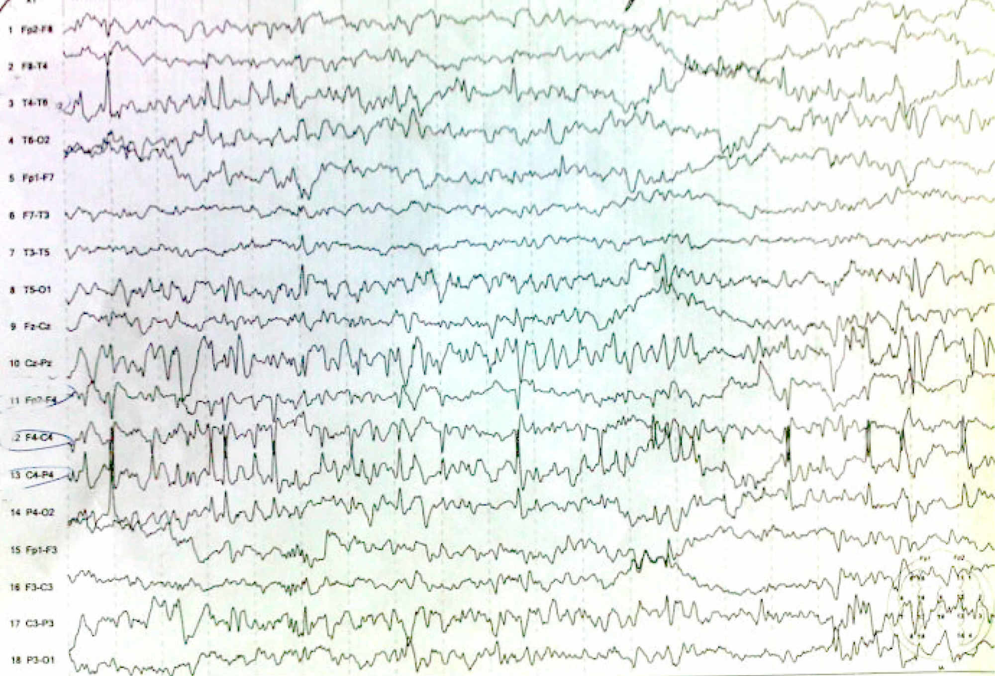 seizures with normal eeg and mri