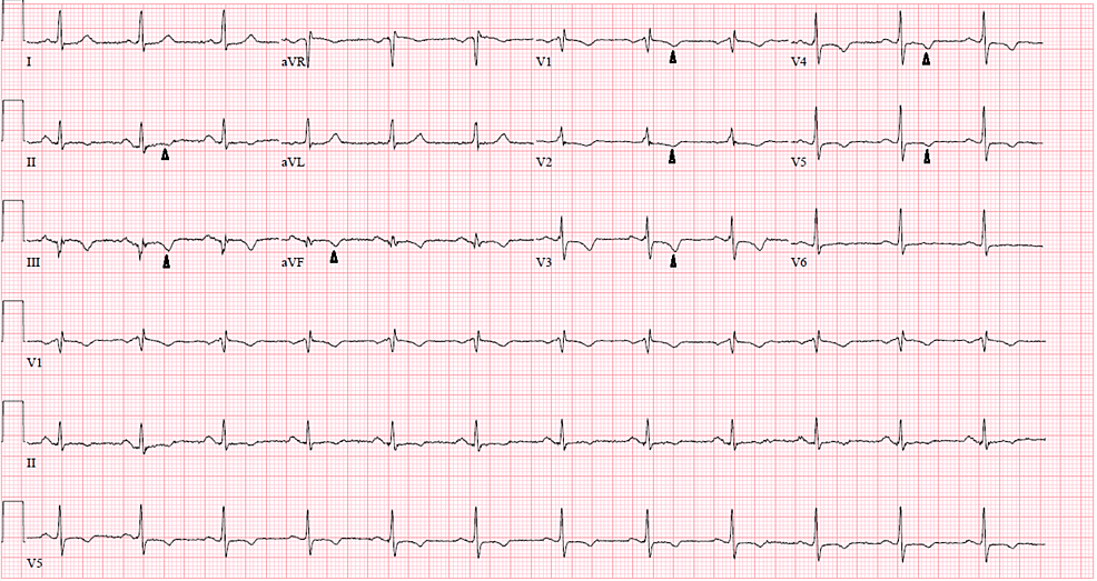 A rare case of a left ventricular thrombus in a normal heart in a patient with Factor V Leiden disease