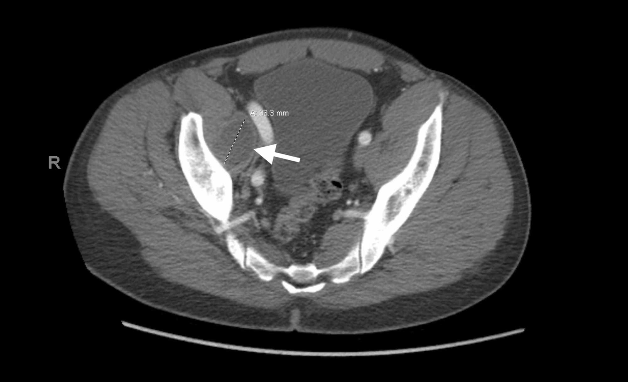 hip replacement metallosis