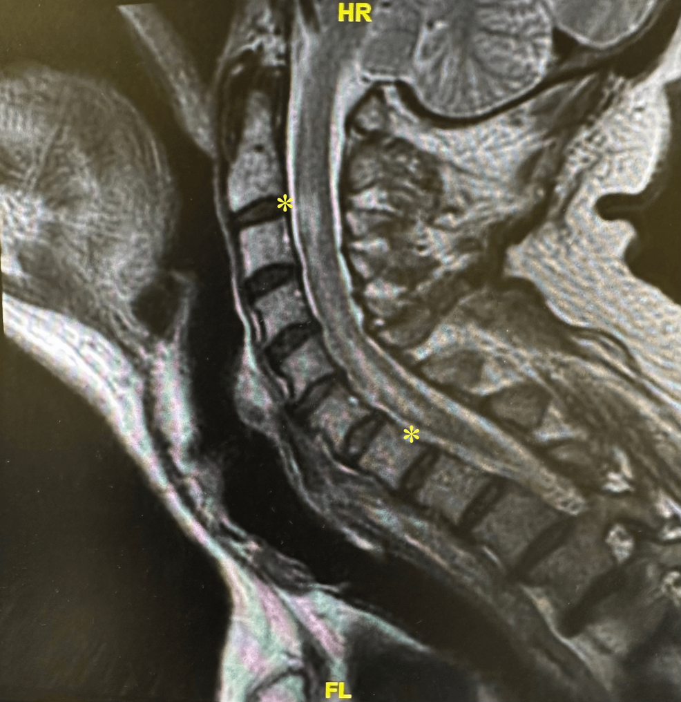 Transverse Myelitis in a 72-Year-Old Male Presenting With Upper ...