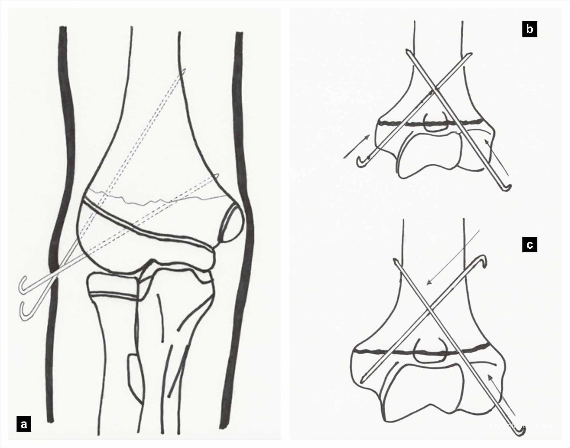 Cureus | Current Management Of Paediatric Supracondylar Fractures Of ...