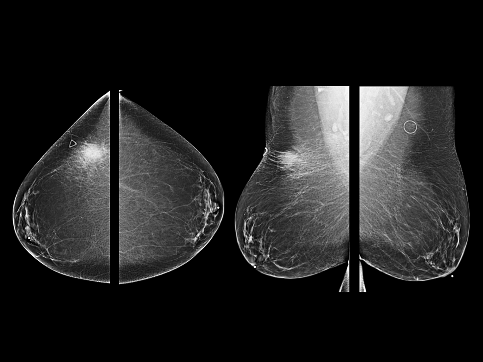 Cureus Rosai Dorfman Disease Of The Breast cureus-rosai-dorfman-disease-of-the-breast