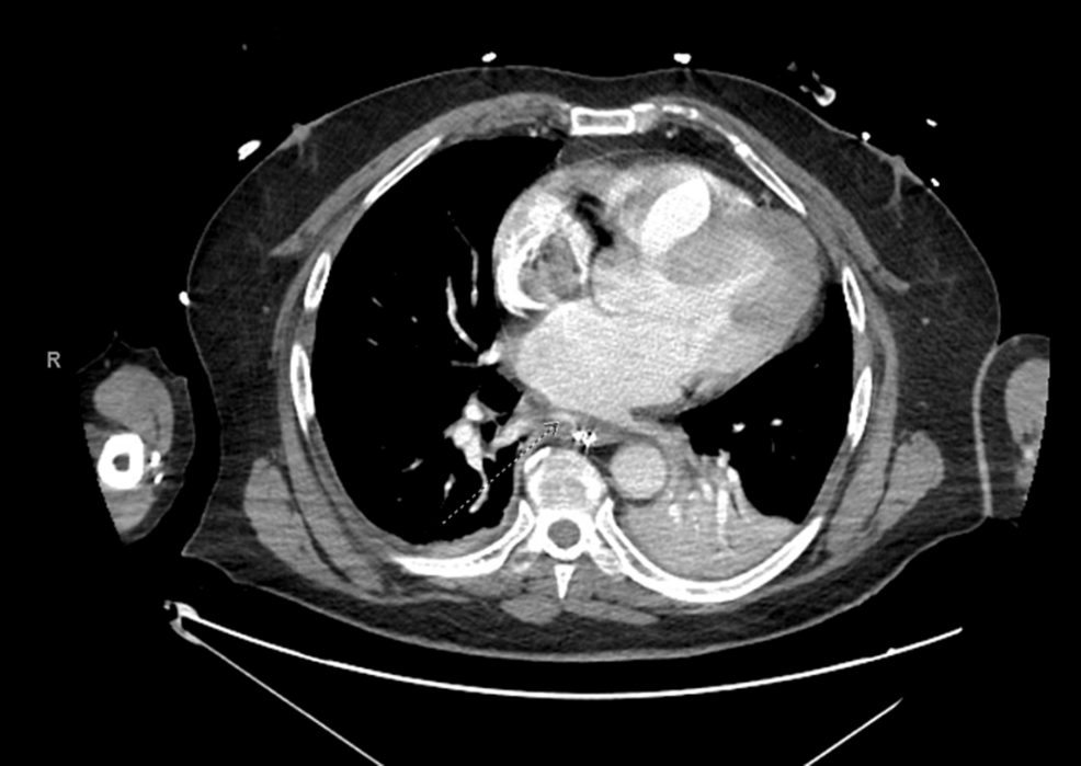 Computed-tomography-angiography-of-chest/abdomen/pelvis-with-contrast-showing-the-atrial-esophageal-fistula-