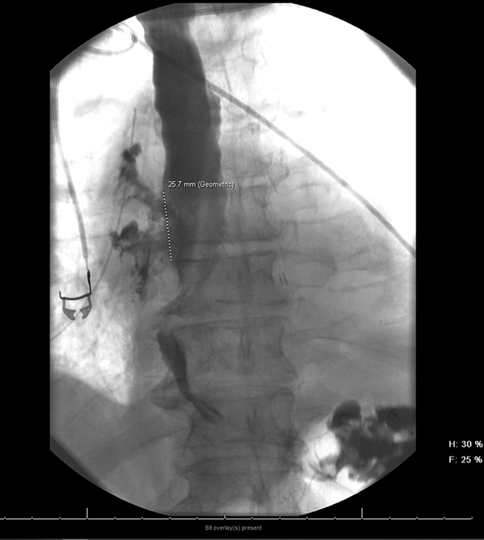 Esophageal-barium-swallow-showing-irregularity-in-the-mid-posterior-wall-of-the-esophagus,-associated-with-a-large-leak-if-contrast-in-the-mediastinum