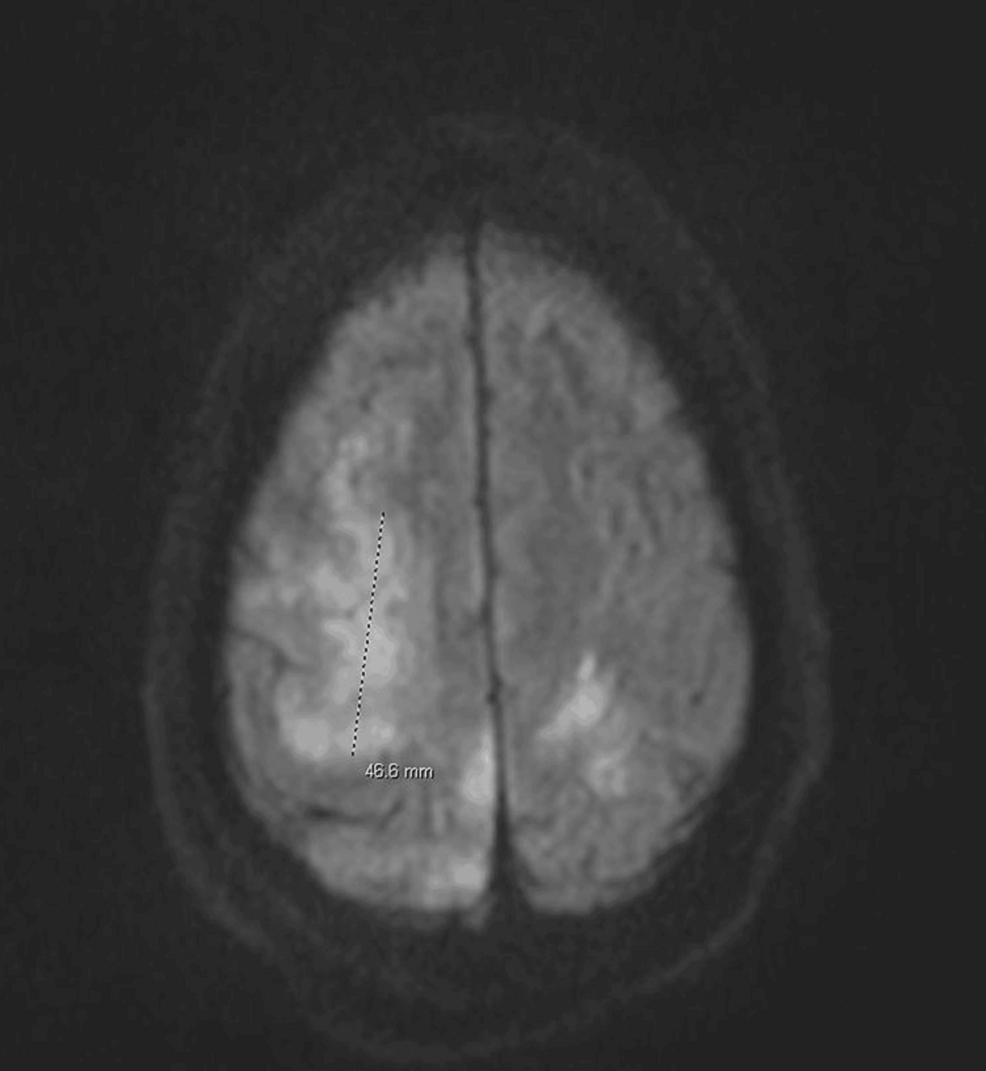 MRI-findings-suggestive-of-acute-embolic-stroke