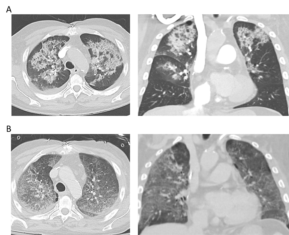 Cureus Unilateral Diffuse Alveolar Hemorrhage Due To Selective Images