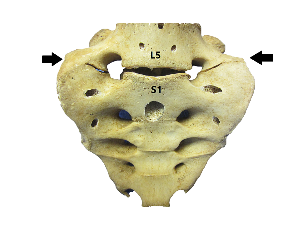 Sacralization-of-the-fifth-lumbar-vertebrae