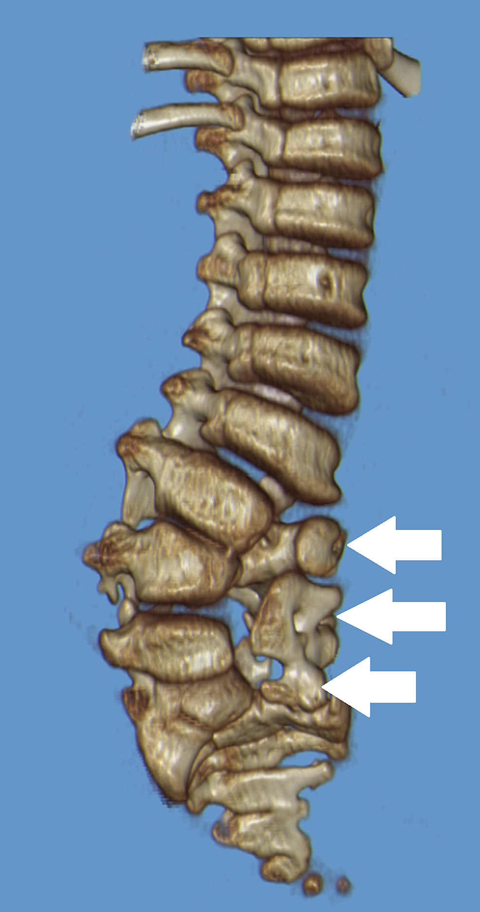 Spinal-dysraphism-at-lumbosacral-region