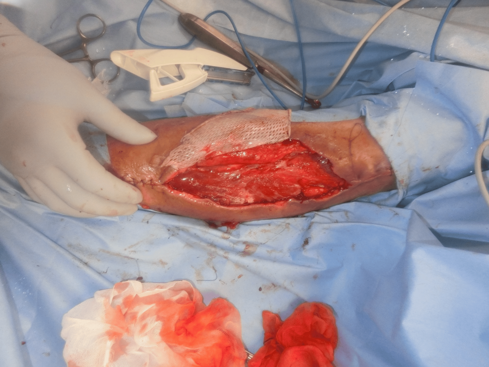 After-hematoma-removal,-at-the-time-of-skin-graft-surgery