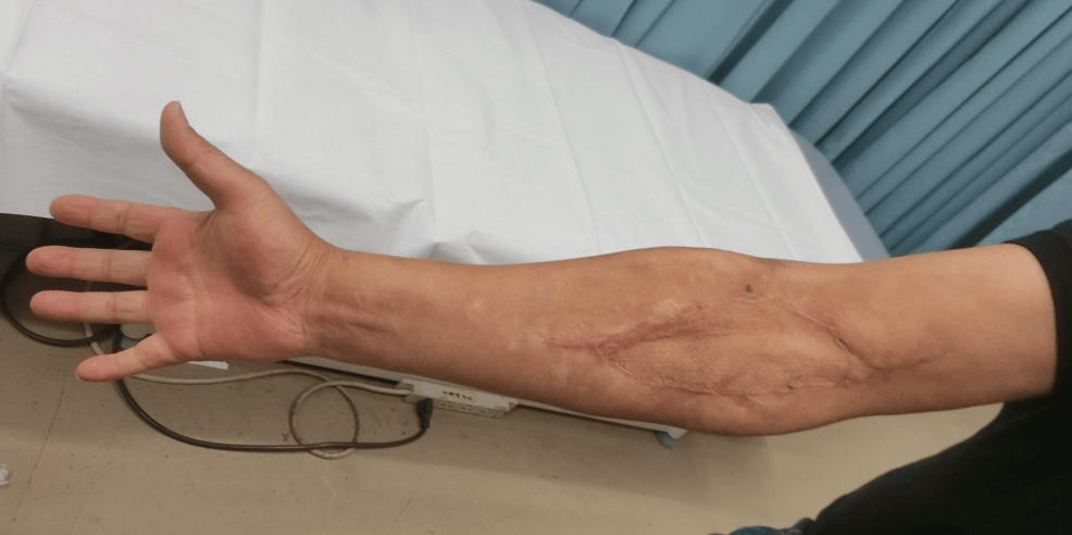 Implanted-skin-area-at-one-year-after-discharge