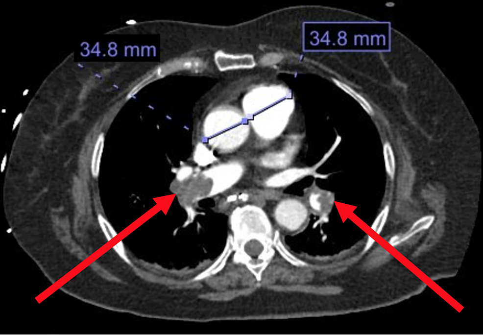 Cureus Massive Pulmonary Embolism in a Recent Intracranial Hemorrhage
