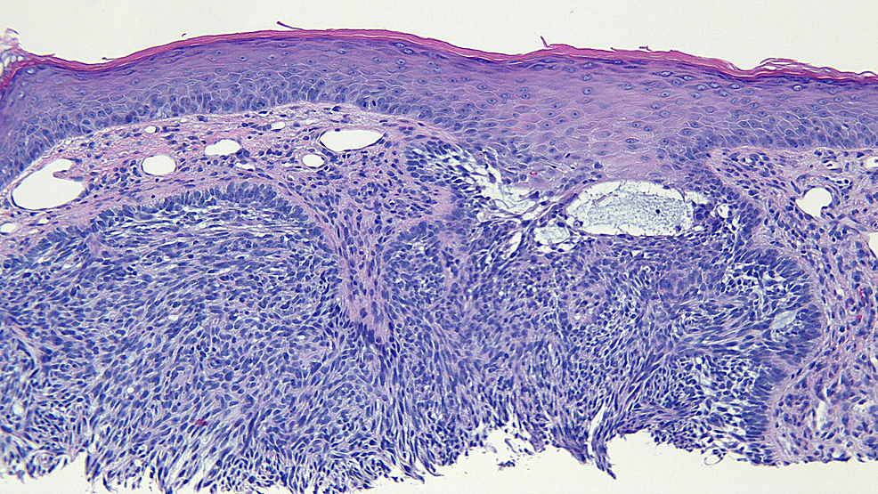 Cureus | Red Dot Basal Cell Carcinoma: Report of Cases and Review of ...