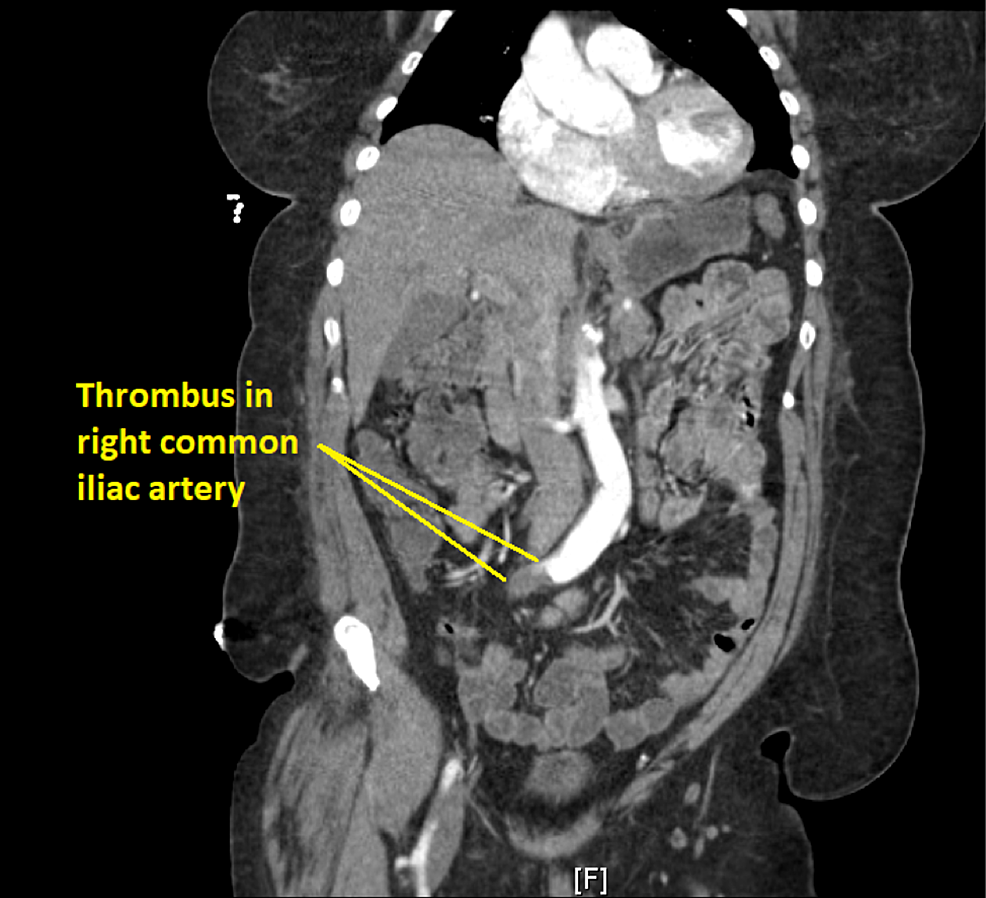 CT-scan-illustrating-right-common-iliac-artery-occluded-by-a-thrombus.