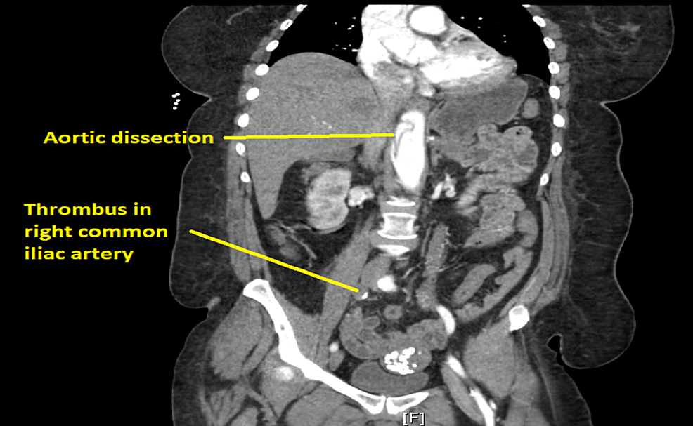 CT-scan-showing-thrombus-occluding-right-common-iliac-artery-and-aortic-dissection.