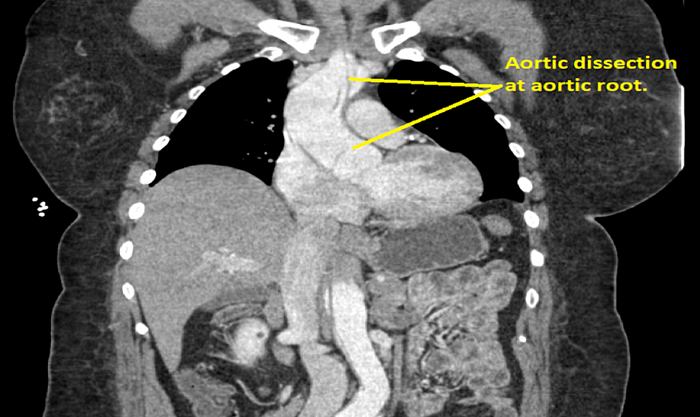 CT-scan-showing-dissection-at-aortic-root. 