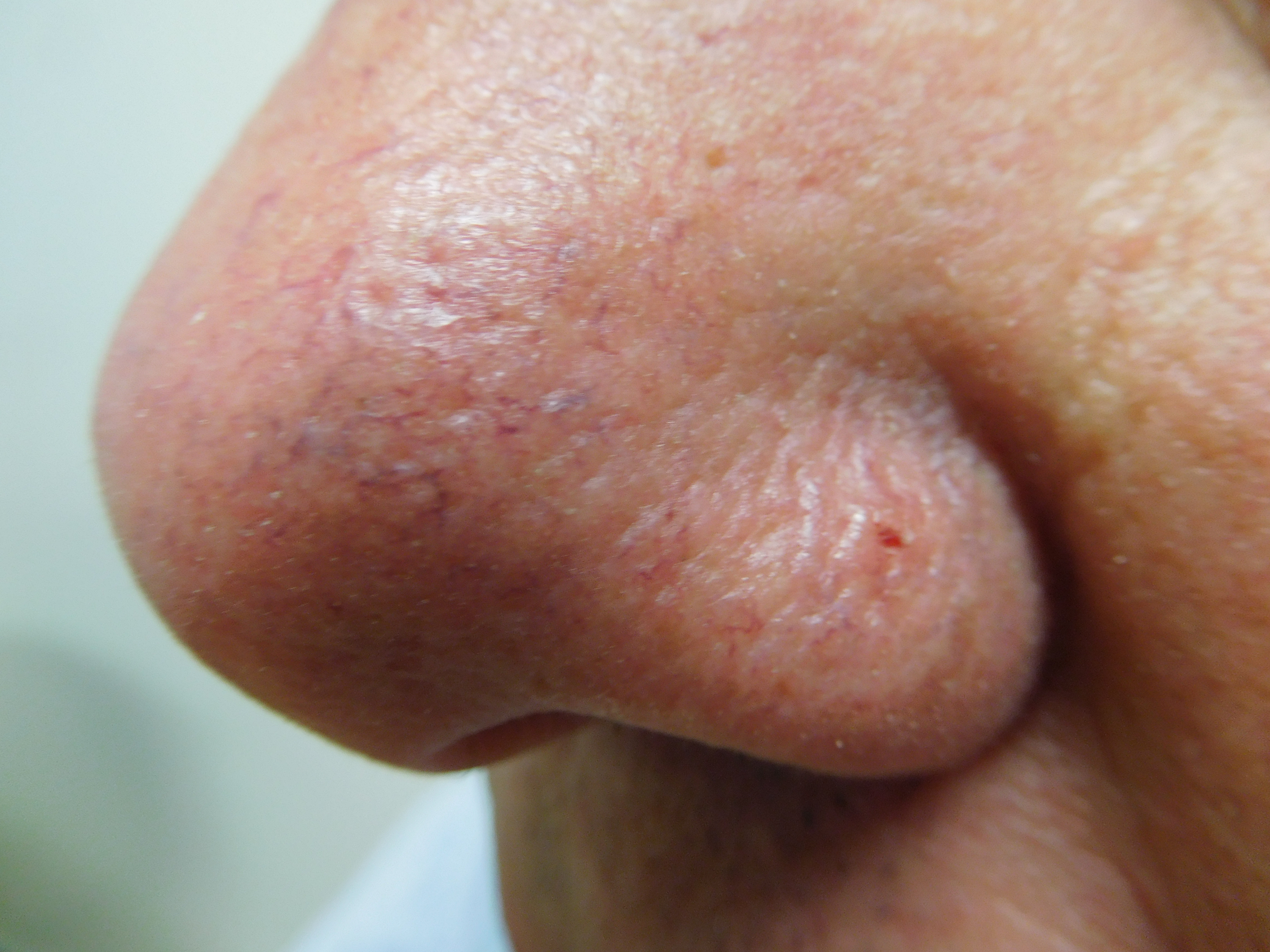 Basal Cell Carcinoma Nose Treatment