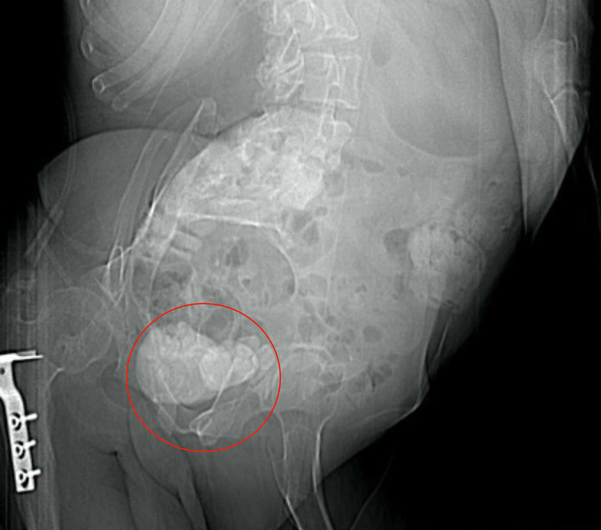 Cureus Total Osseous Calcification of the Prostate Gland