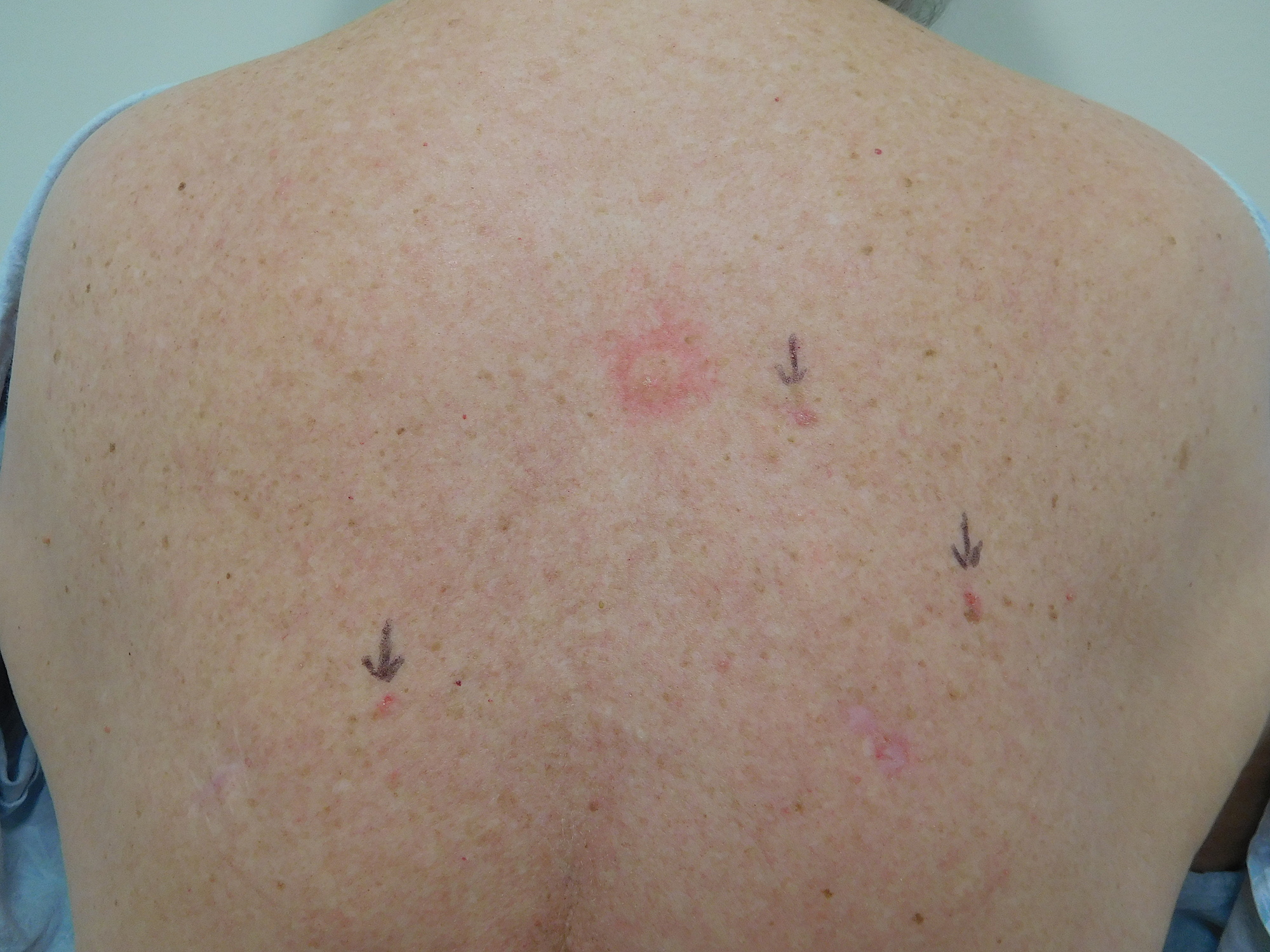 Cureus Red Dot Basal Cell Carcinoma Report Of Cases And Review