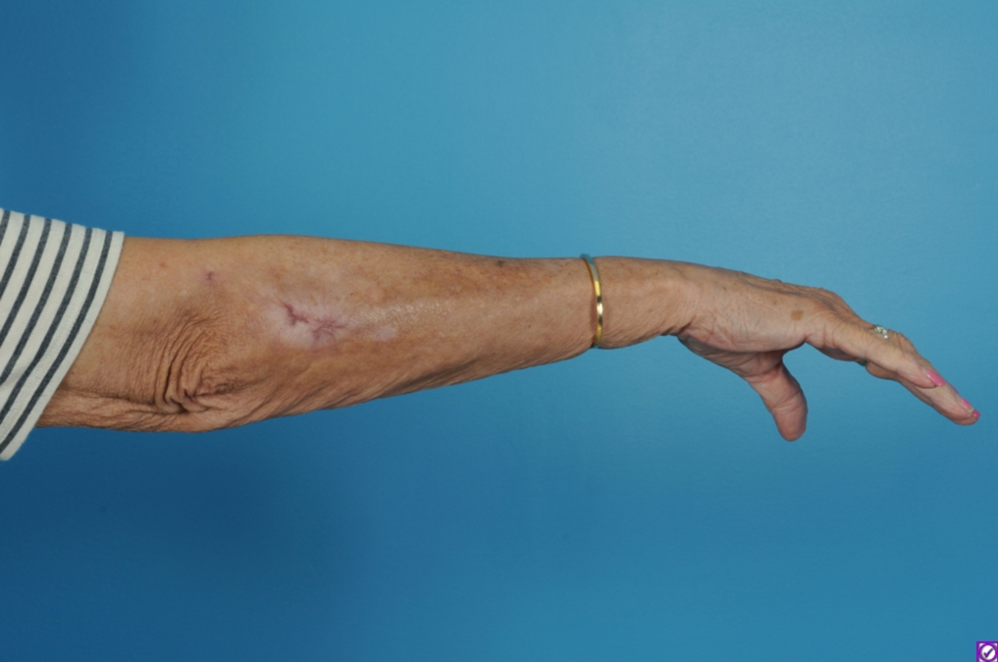 Cureus Novel Use of a Closed Liposuction System Treatment of an