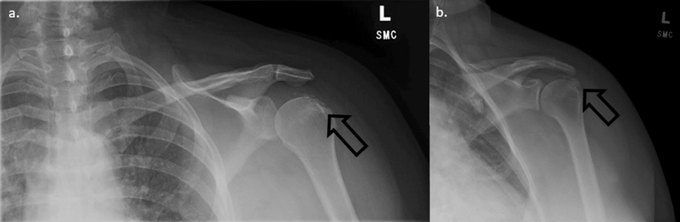 Ultrasound-Guided Glucocorticoid Injection as a Treatment ... - Cureus