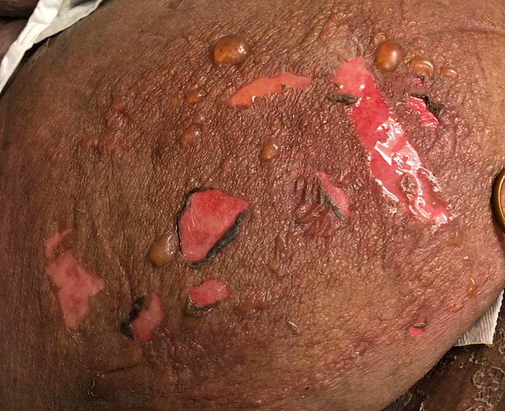 Bullae-and-positive-Nikolsky’s-sign-on-the-lateral-aspect-of-the-patient's-right-thigh-one-day-after-admission