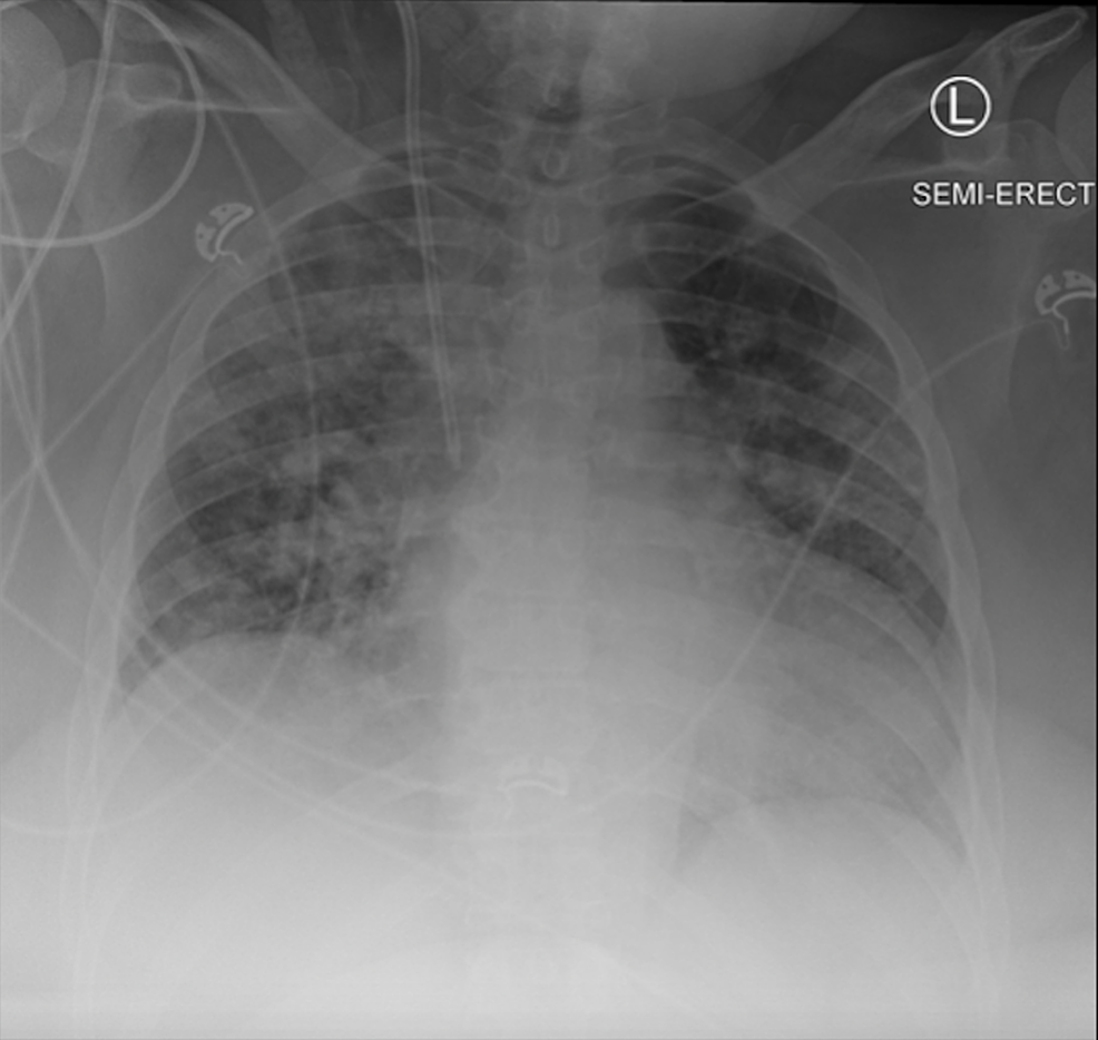 -Chest-radiograph-obtained-at-our-institution-on-the-day-of-the-patient's-transfer-from-the-outside-hospital