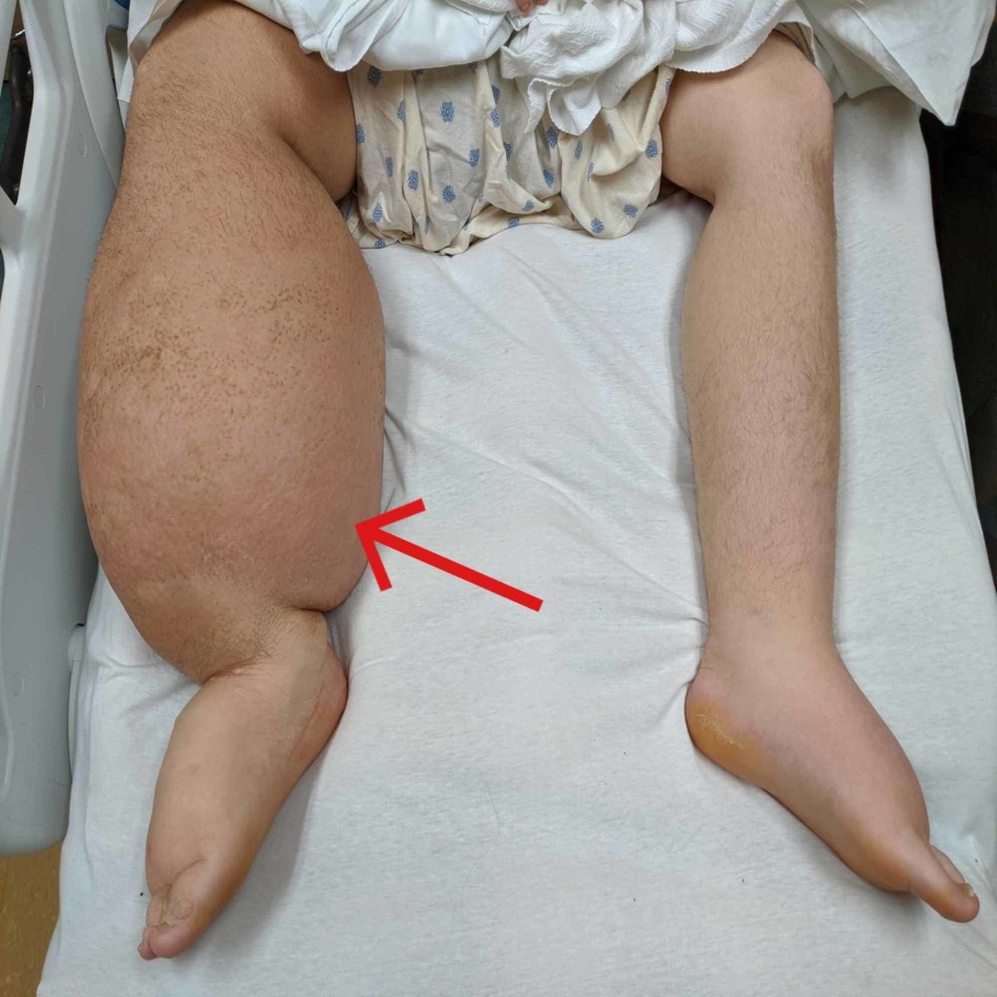 Cureus | A Case of Congenital Lymphedema Complicated by Chronic Chylous