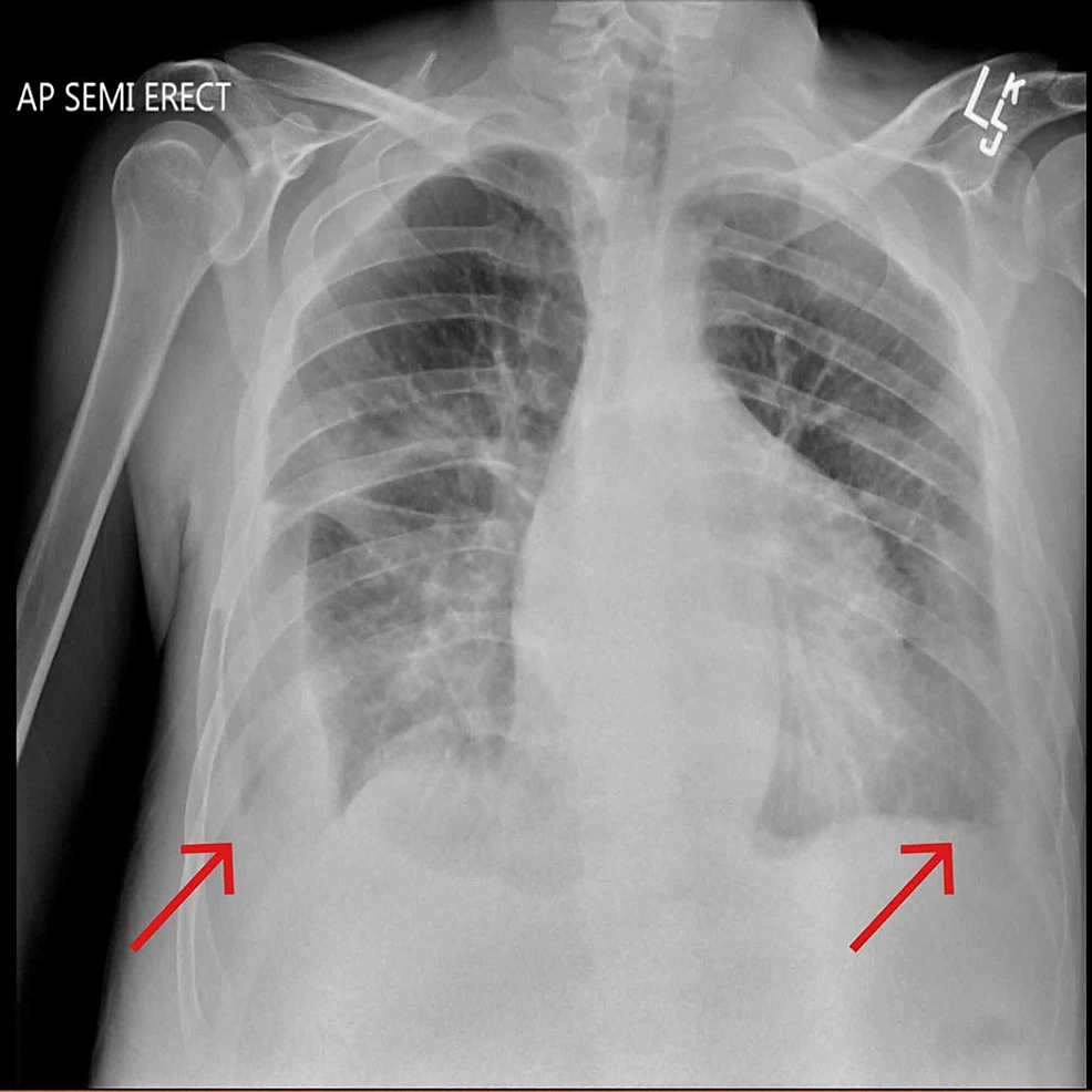 Pericardial Effusion Chest X Ray