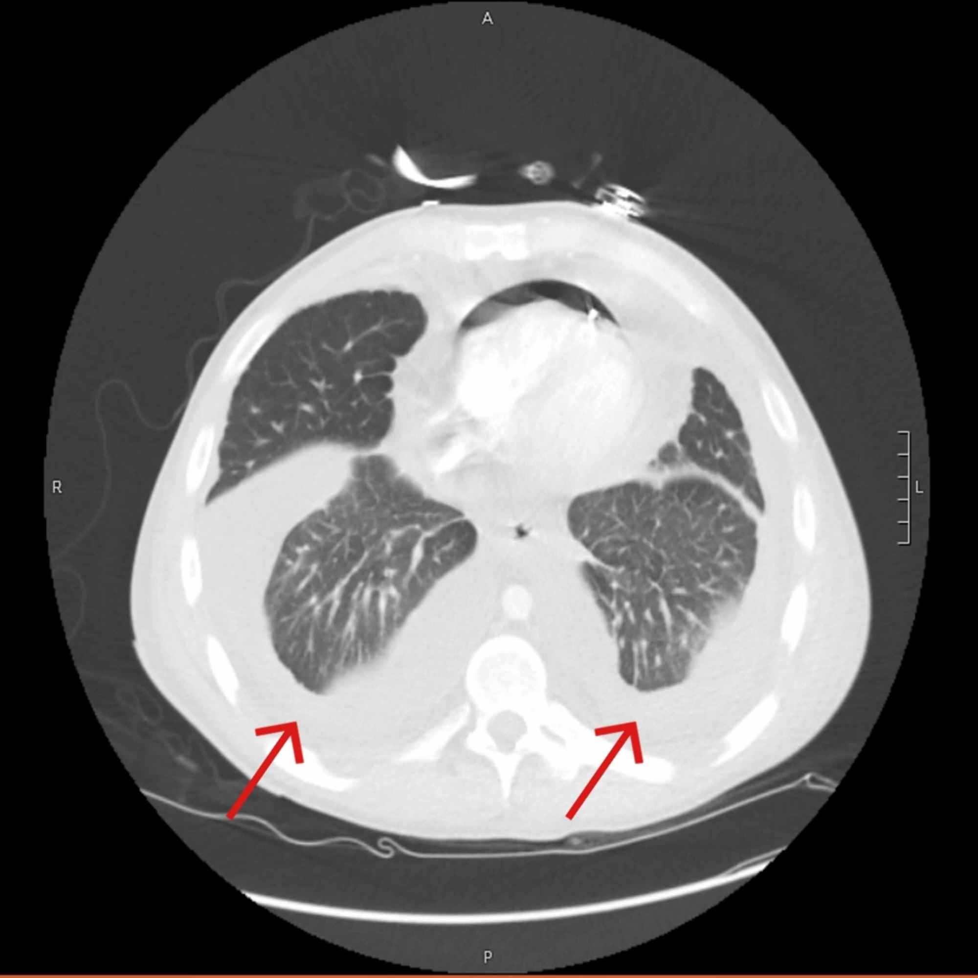 Figure 3 From Malignant Pleural And Pericardial Effus - vrogue.co