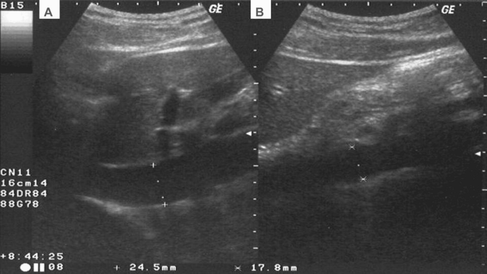 Ultrasound-measurement-point-location-for-eIVC-and-aorta