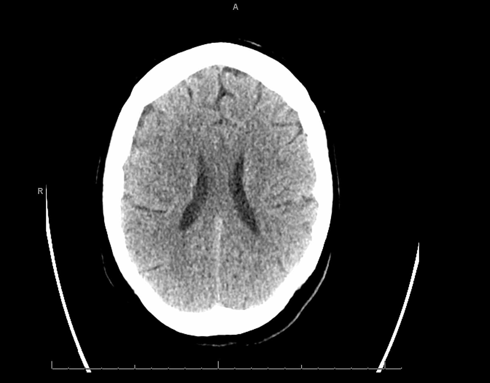 Non-contrast-computed-tomography-(CT)-of-the-head-hours-after-symptom-onset-without-signs-of-an-acute-infarct