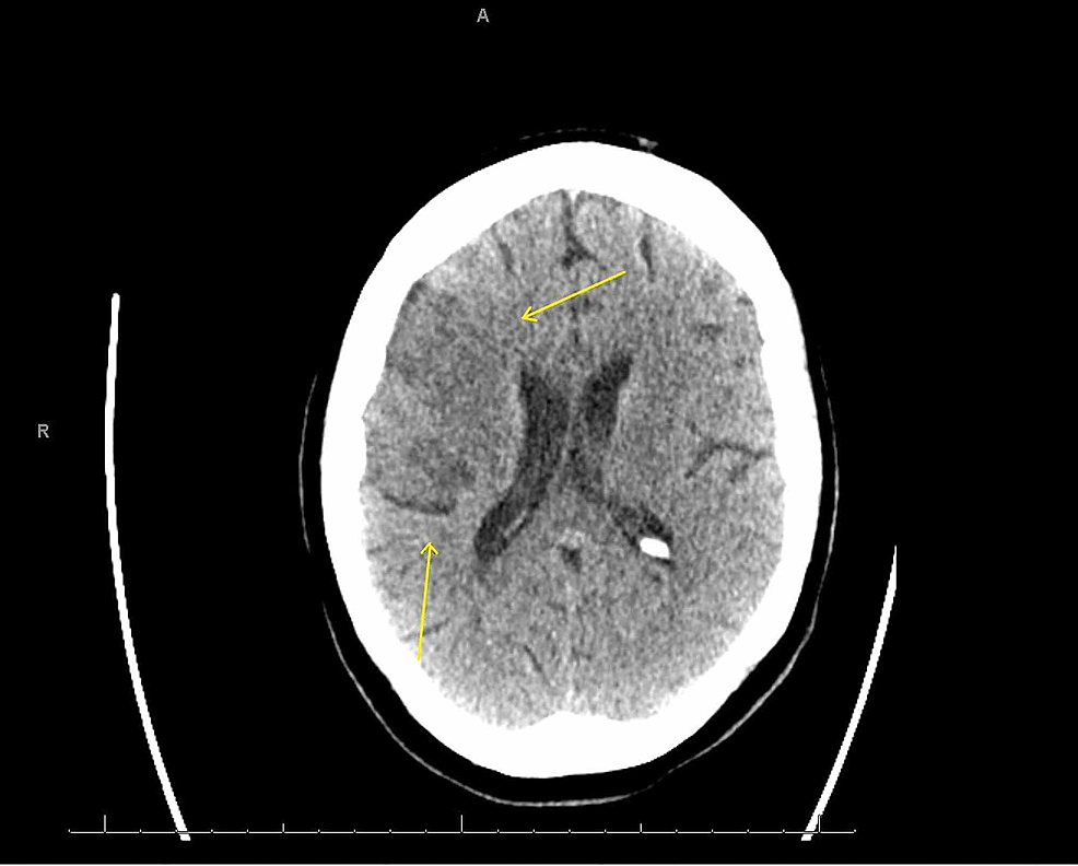 Non-contrast-computed-tomography-(CT)-of-the-head-eight-days-after-symptom-onset-significant-for-a-new-hypodensity-in-the-right-middle-cerebral-artery-(MCA)-distribution-(arrows)