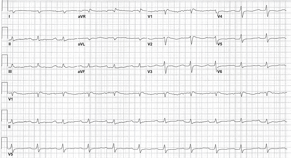 Cureus | Cardiac Dysrhythmia Associated With Opioid Toxicity