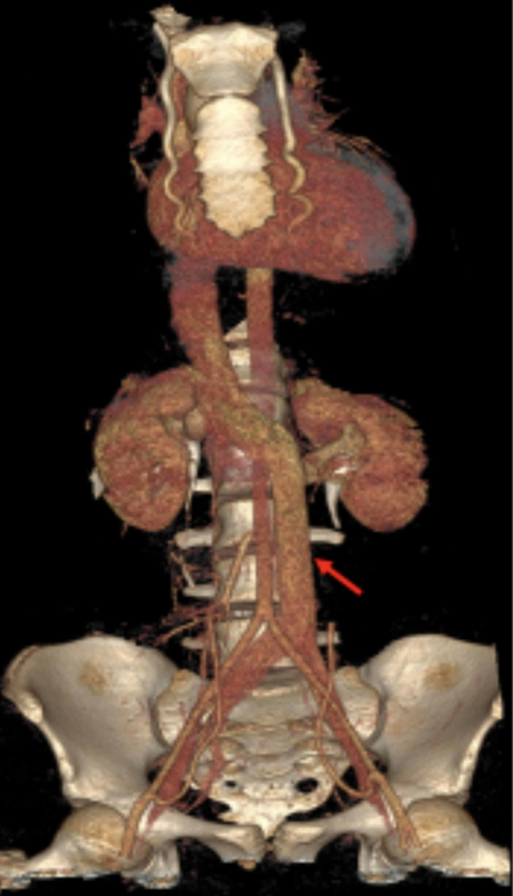 Cureus Transcatheter Intervention For Severe Aortic