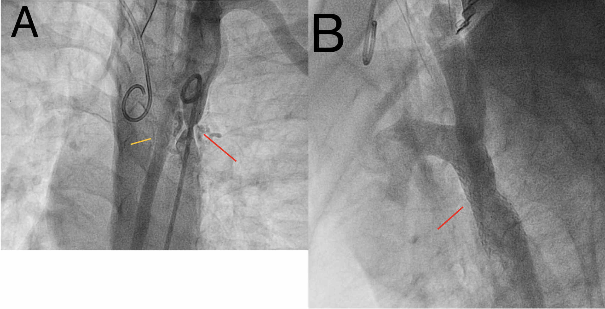 aortic arch angiogram cpt code