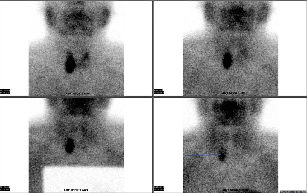 Hypercalcemia In Dual Pathology Interplay Between Renal Cell Carcinoma And Parathyroid Adenoma