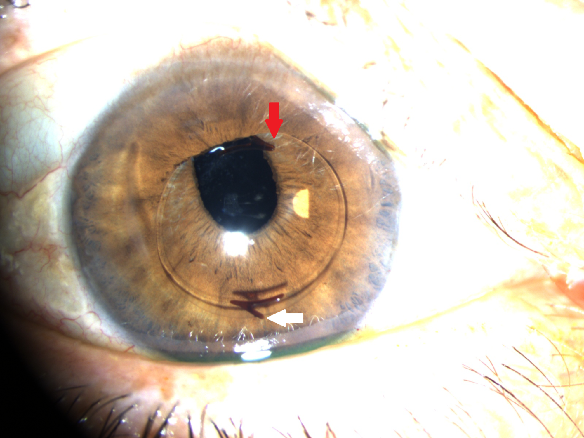 Moederland buis Afscheid Cureus | Late Intraocular Lens Dislocation Resulting From Haptic Breakage  Following Cardiopulmonary Resuscitation | Article