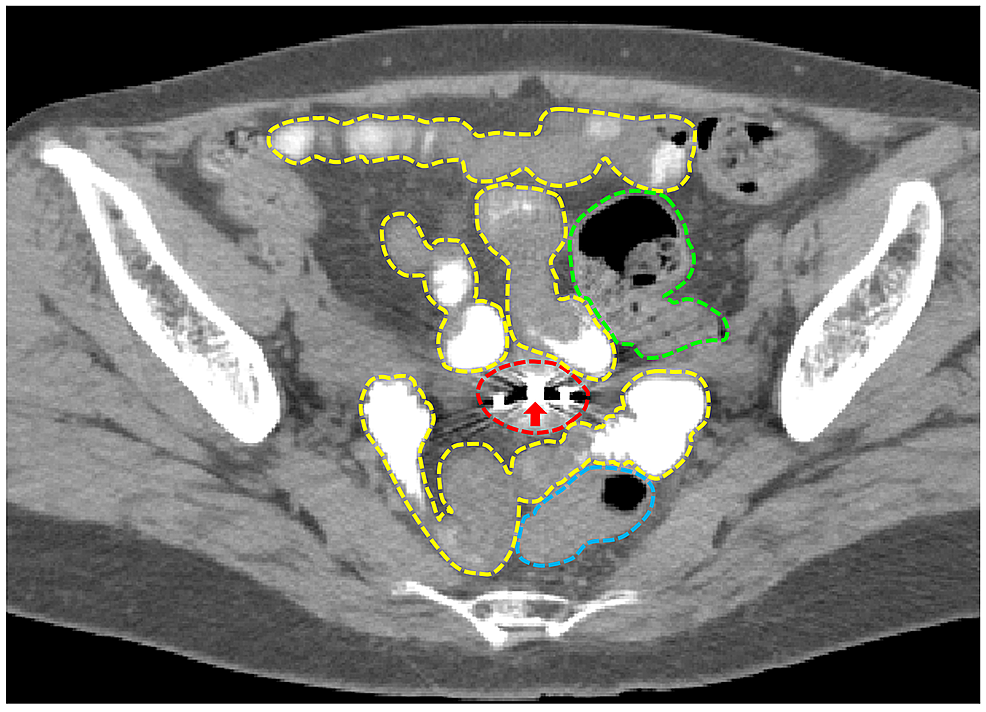 Cureus Oral Gastrografin Facilitates Delineation Of Intestinal Tracts In Ct Based 2026